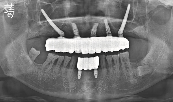 黃 All-on-5 顴骨植牙 術前術後X光