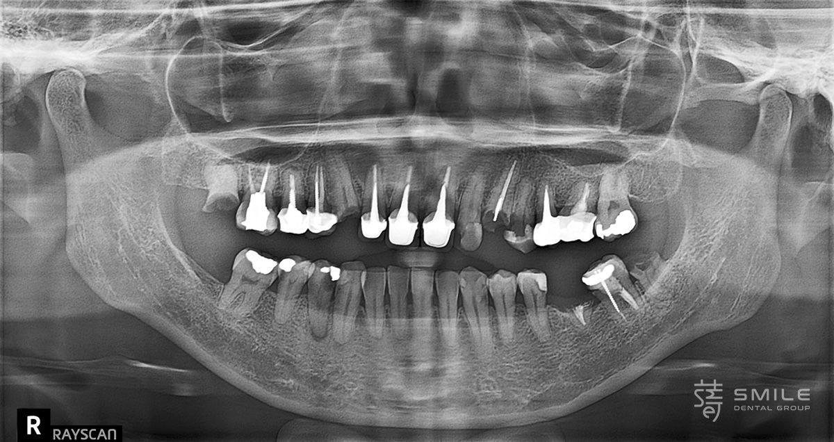 202407020307351479155235_0680604-1 從恐懼到重生:全口植牙重建讓陳太太重拾美食人生