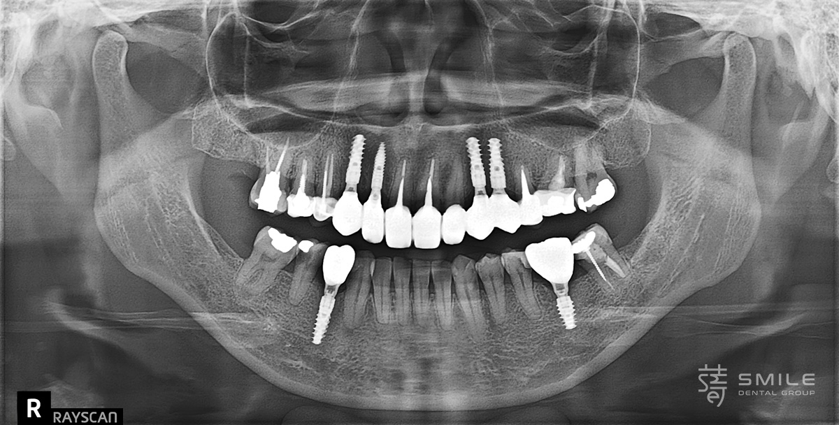 2025061205065455433381_0680604-2 從恐懼到重生:全口植牙重建讓陳太太重拾美食人生
