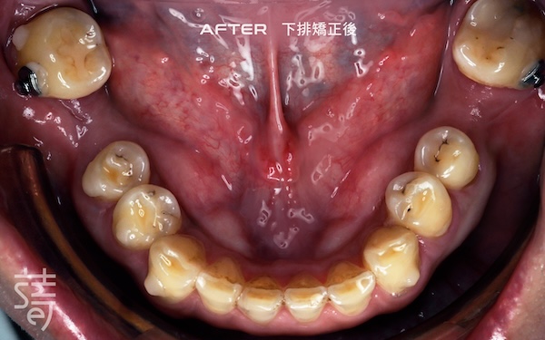 2下排矯正後 1181