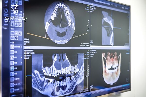 3D電腦斷層笑容蛻變之旅：DSD讓瓷牙貼片更自然