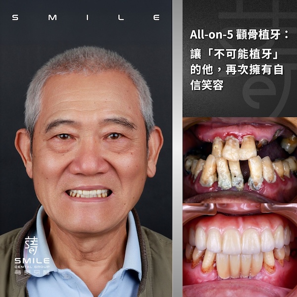 官網案例封面 - All-on-5 顴骨植牙：讓「不可能植牙」的他，再次擁有自信笑容