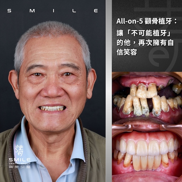 官網案例封面 - All-on-5 顴骨植牙：讓「不可能植牙」的他，再次擁有自信笑容