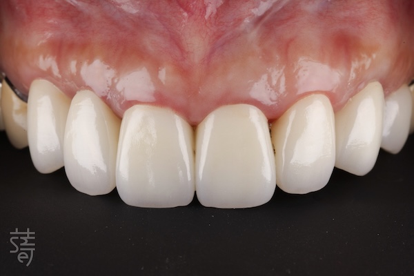 _MG_0003 從恐懼到重生:全口植牙重建讓陳太太重拾美食人生