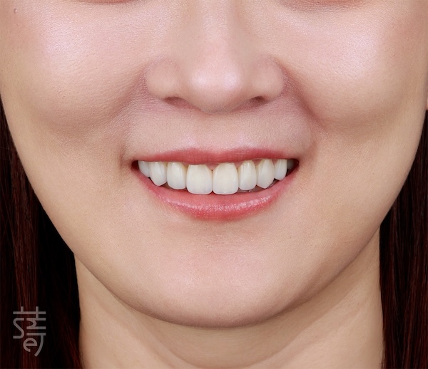 _MG_0019笑容蛻變之旅：DSD讓瓷牙貼片更自然