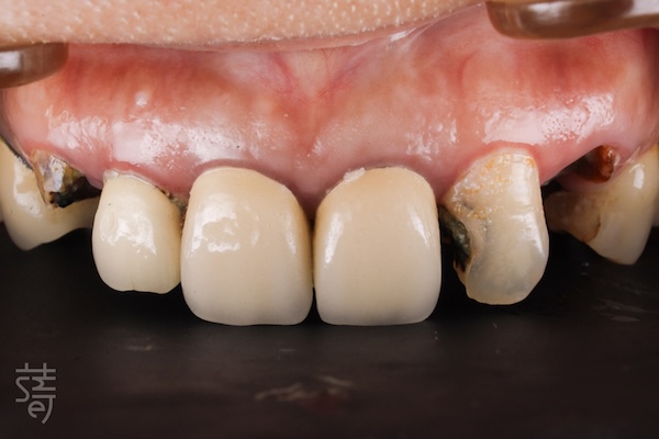 _MG_9524 從恐懼到重生:全口植牙重建讓陳太太重拾美食人生拷貝