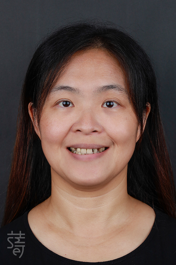 _MG_9536黃植牙從恐懼到重生:全口植牙重建讓陳太太重拾美食人生