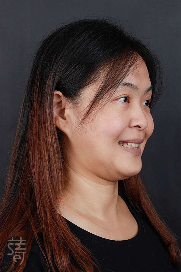 _MG_9538黃植牙從恐懼到重生:全口植牙重建讓陳太太重拾美食人生