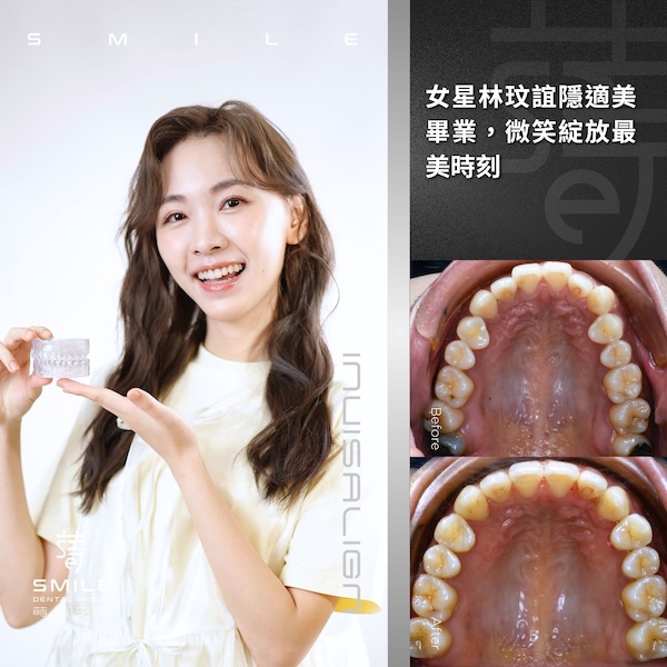 官網案例封面 - 女星林玟誼隱適美畢業，微笑綻放最美時刻