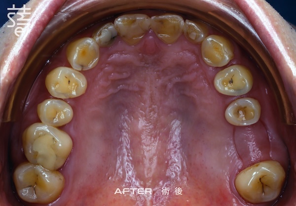 李 先生 蒔美 薛聖儒 磨牙2 上排矯正後