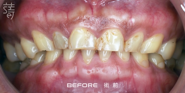 李 先生 蒔美 薛聖儒 磨牙術前調整 IMG_7718