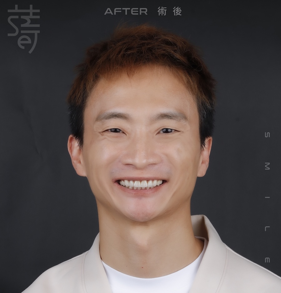 李 先生 蒔美 薛聖儒 磨牙術後_MG_0433