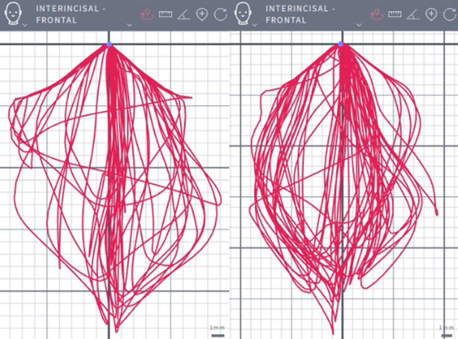 治療前後咀嚼軌跡圖