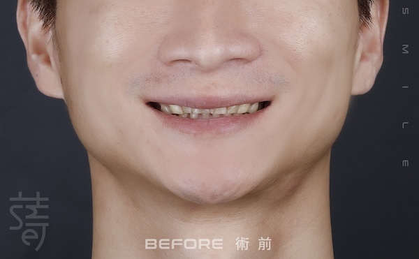 術前 下半顏_MG_7726