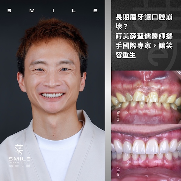 官網案例封面 - 長期磨牙讓口腔崩壞？ 蒔美薛聖儒醫師攜手國際專家，讓笑容重生
