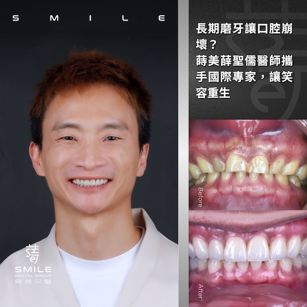 官網案例封面 - 女星林玟誼隱適美畢業，微笑綻放最美時刻