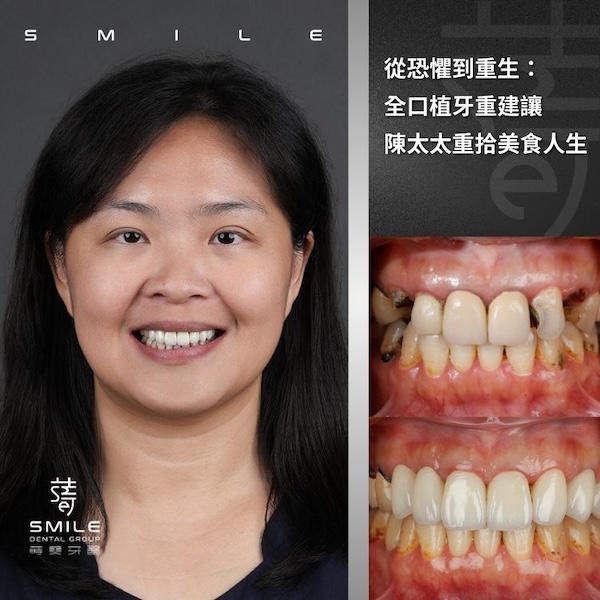 官網案例封面 - 從恐懼到重生：全口植牙重建讓陳太太重拾美食人生
