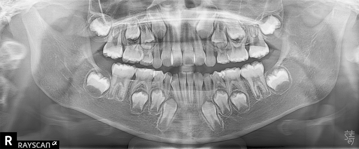 緹01兒童隱適美 × 肌功能訓練：8歲孩子的早期矯正，從害羞到自信大笑的蛻變旅程