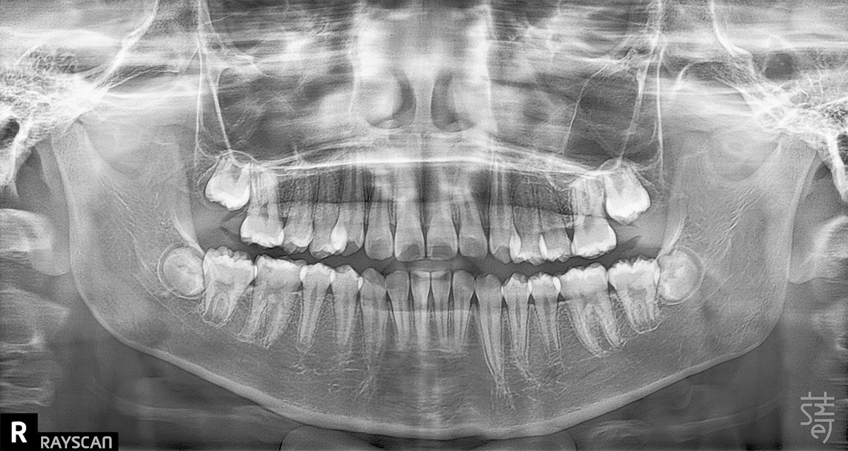 20240419兩年追蹤 緹-pano兒童隱適美 × 肌功能訓練：8歲孩子的早期矯正，從害羞到自信大笑的蛻變旅程