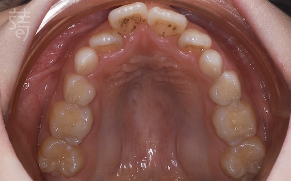 DSC_2297兒童隱適美 × 肌功能訓練：8歲孩子的早期矯正，從害羞到自信大笑的蛻變旅程