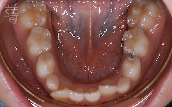 DSC_2299兒童隱適美 × 肌功能訓練：8歲孩子的早期矯正，從害羞到自信大笑的蛻變旅程