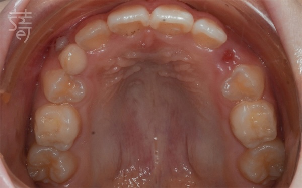 DSC_6463兒童隱適美 × 肌功能訓練：8歲孩子的早期矯正，從害羞到自信大笑的蛻變旅程