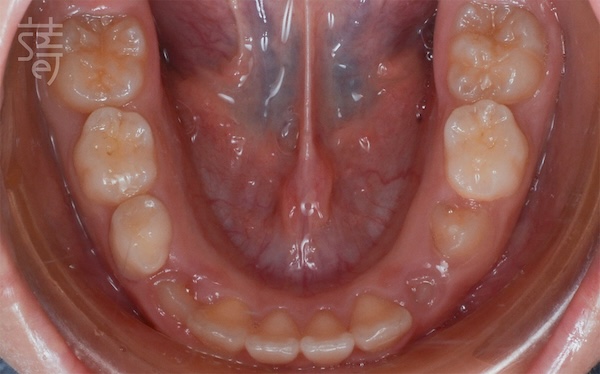 DSC_6466 兒童隱適美 × 肌功能訓練：8歲孩子的早期矯正，從害羞到自信大笑的蛻變旅程