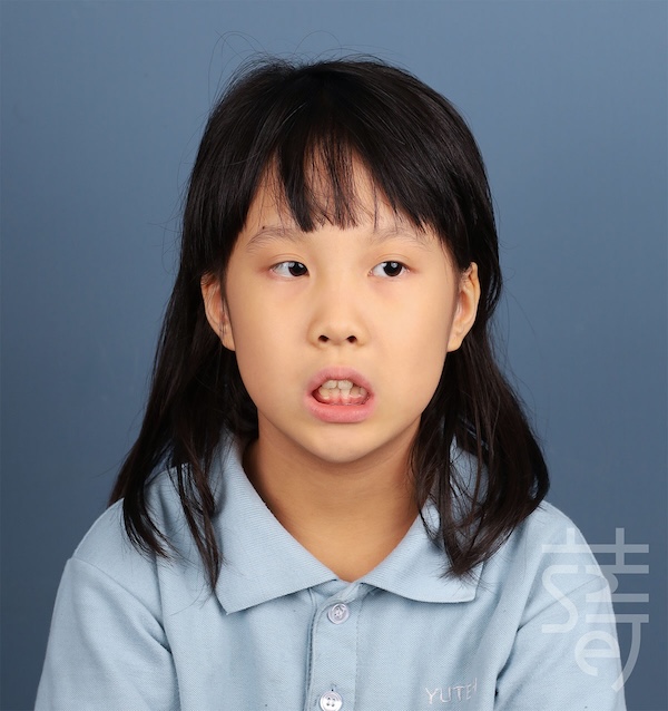 IMG_2437兒童隱適美 × 肌功能訓練：8歲孩子的早期矯正，從害羞到自信大笑