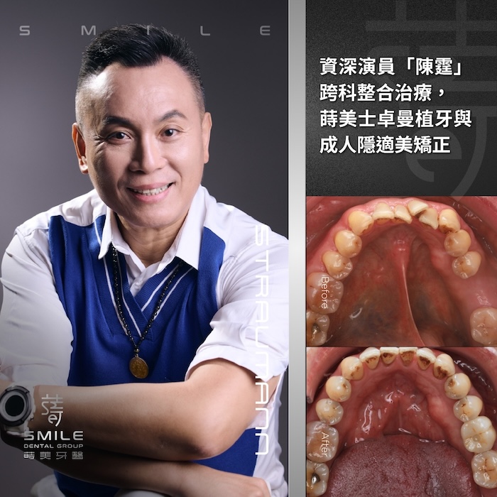 Straumann植牙案例-台北植牙推薦-蒔美牙醫-陳霆－700