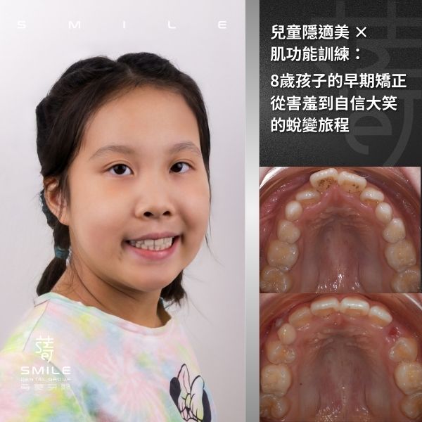 兒童隱適美 × 肌功能訓練：8歲孩子的早期矯正，從害羞到自信大笑的蛻變旅程