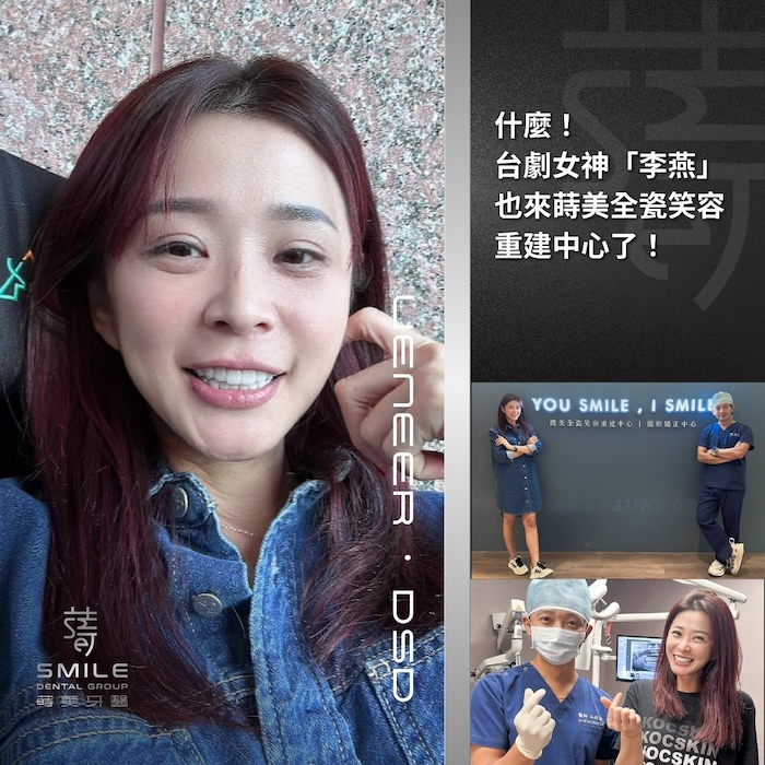 全瓷貼片案例-台北陶瓷貼片推薦-蒔美牙醫-13-台劇女神李燕－700