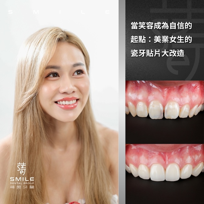 當笑容成為自信的 起點：美業女生的 瓷牙貼片大改造