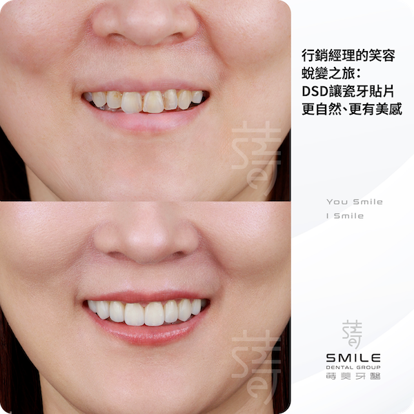 行銷經理的笑容蛻變之旅DSD讓瓷牙貼片更自然