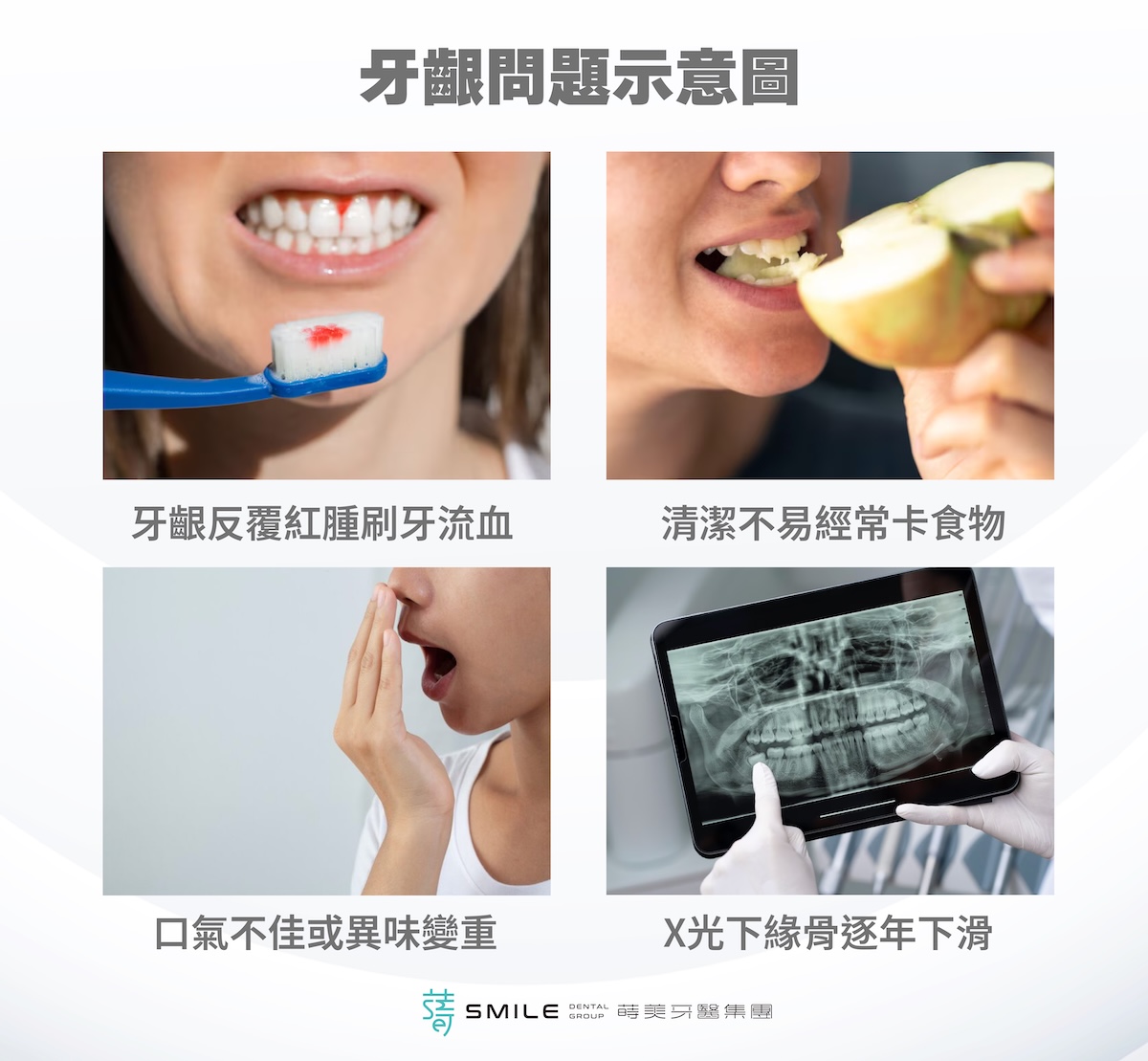 植牙的第s一道防線 2