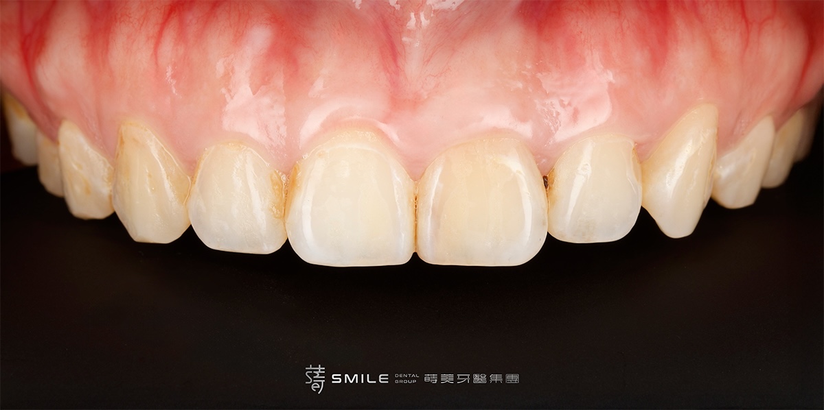 術前背板_MG_4825