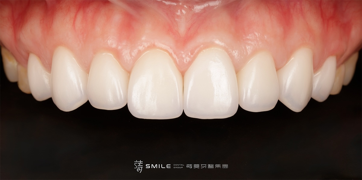 術後背板_MG_0070