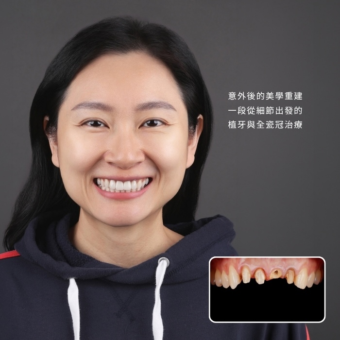 意外後的美學重建 一段從細節出發的植牙與全瓷冠治療