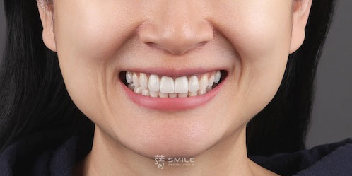 江-術後全臉IMG_0371躍-全瓷