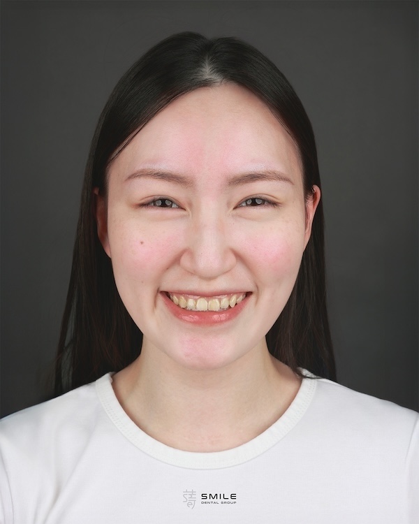 術前全臉_MG_5057