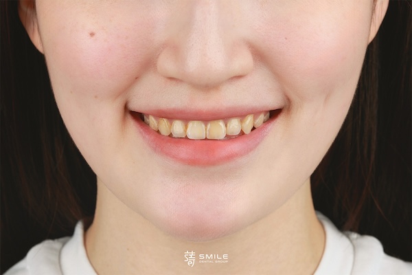 術前半臉_MG_4811