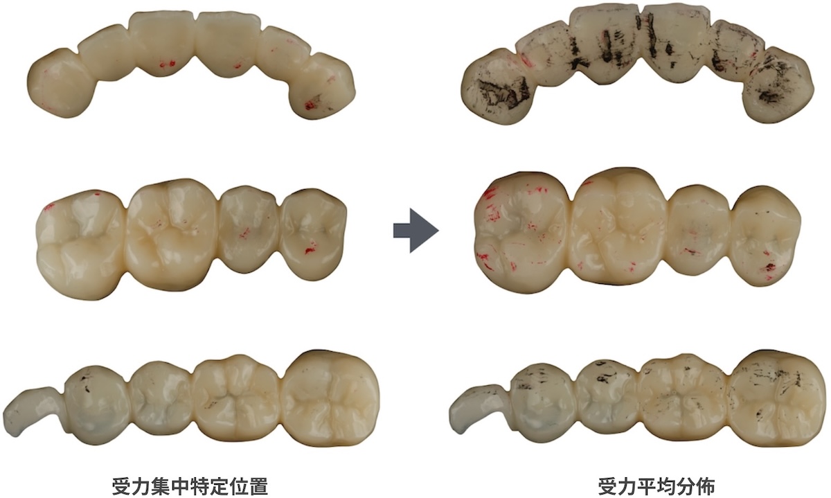 咬合調整001受力集中特定位置
