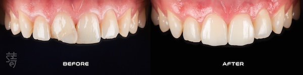 2 0K0A9720-02 (1) 一日假牙案例