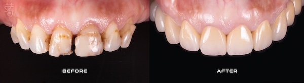 2 0K0A9720-02 一日假牙案例