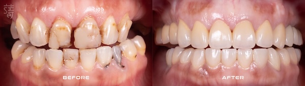 2 0K0A9720-03 一日假牙案例