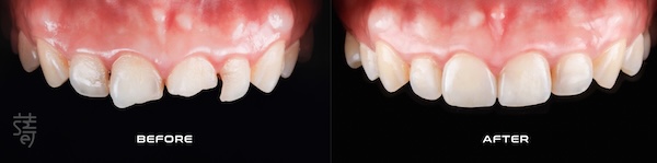 2 0K0A9720 一日假牙案例