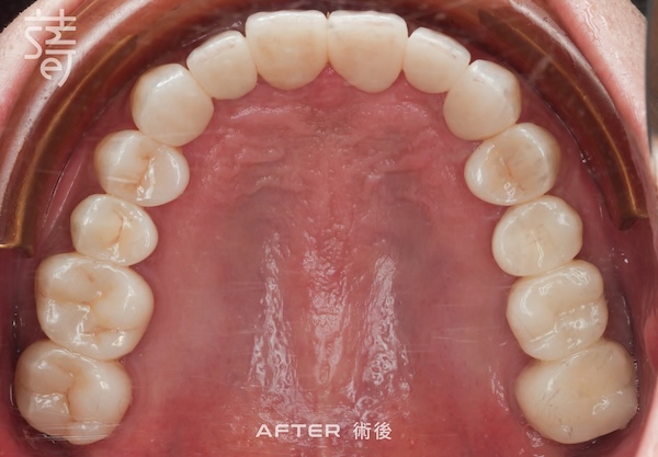 600術後-拷貝2上排假牙完成_IMG_0437