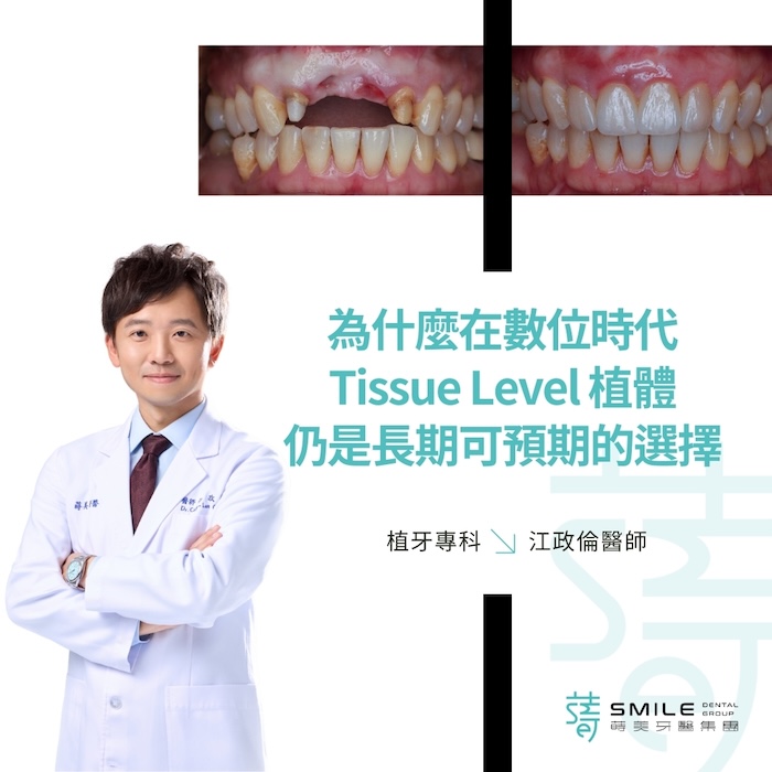 為什麼在數位時代，Tissue Level 植體仍是長期可預期的選擇