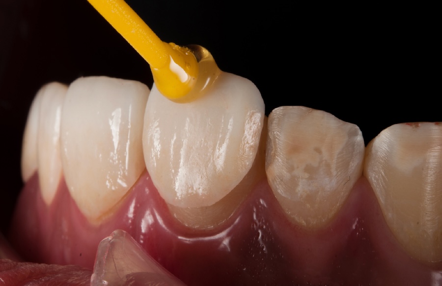 蒔美數位一日假牙如何完成-(1)_07