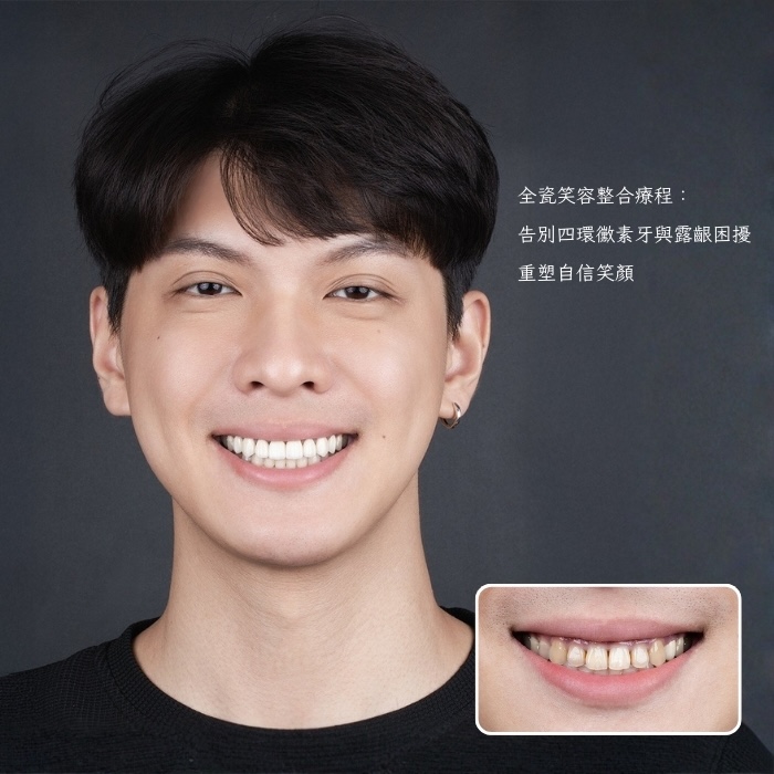 全瓷笑容整合療程:告別四環黴素牙與露齦困擾,重塑自信笑顏