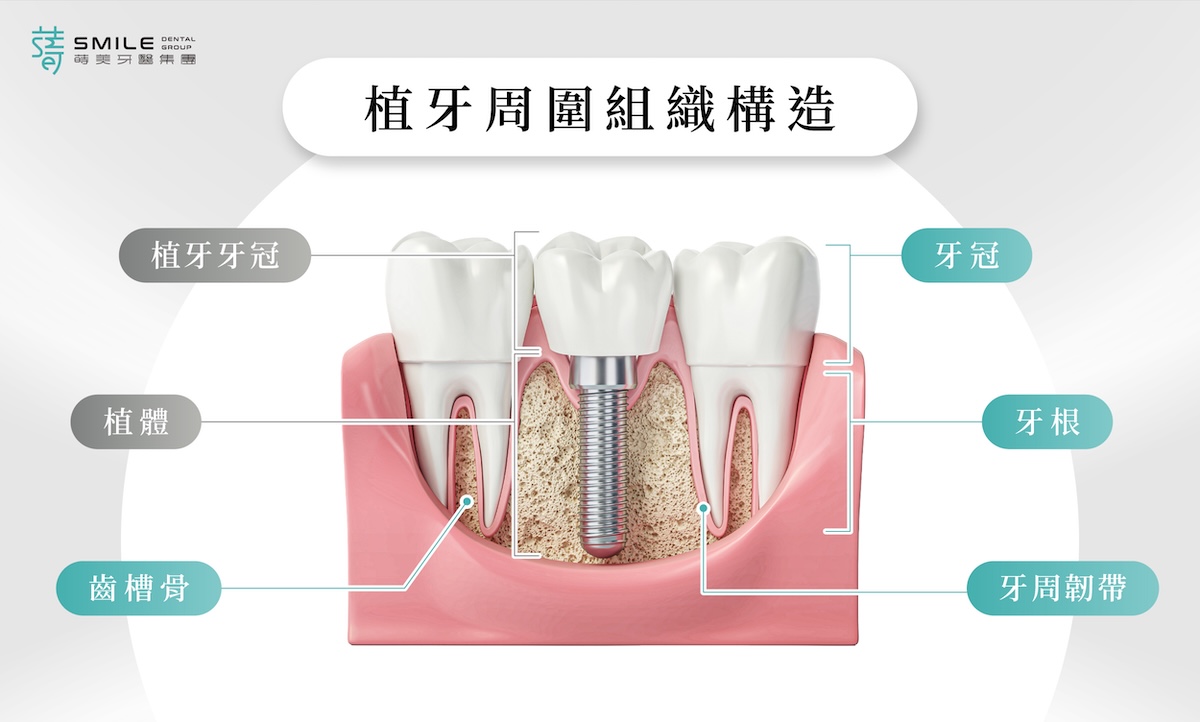 植牙 牙齦生物屏障-03